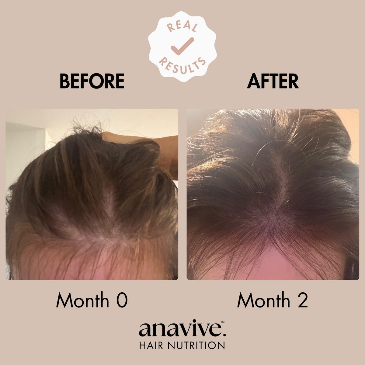 Anavive Hair Nutrition - 1 Month Supply